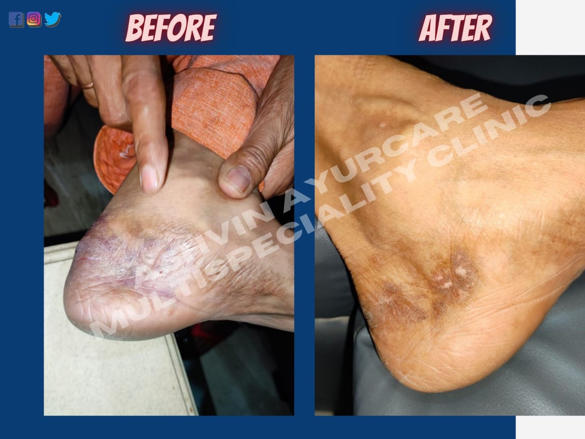 Before After Treatment