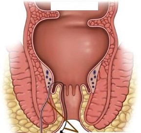 Kshar Sutra Treatment
