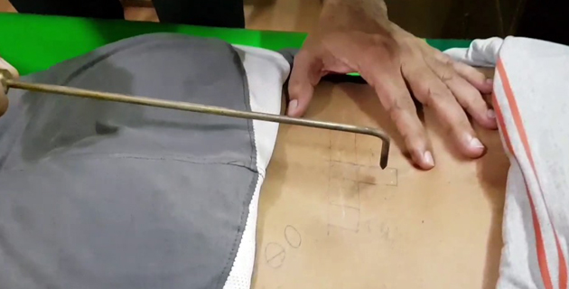 Parasurgical Procedure